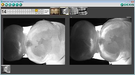 Dexis CariVu cavity detection device - Hoboken dentist